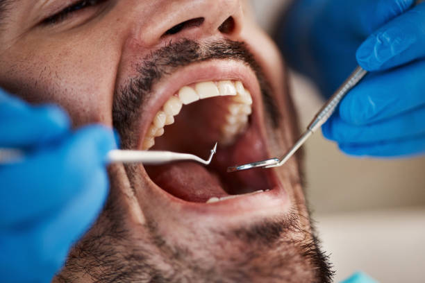 Best Dental Fillings (Composite and Amalgam)  in Bothell, WA